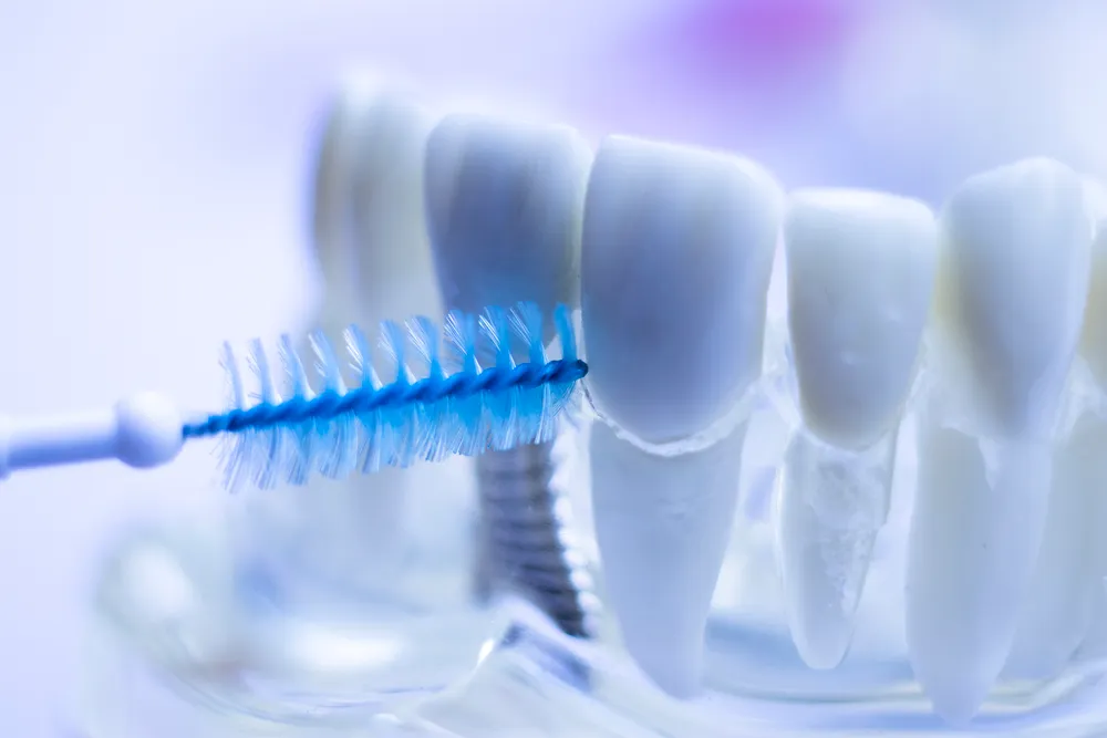 Die Vorteile von Interdentalbürsten für die Zähne